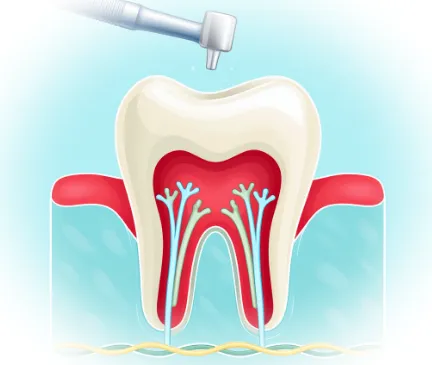 Какие бывают пломбы и какая лучше подойдет именно вам?